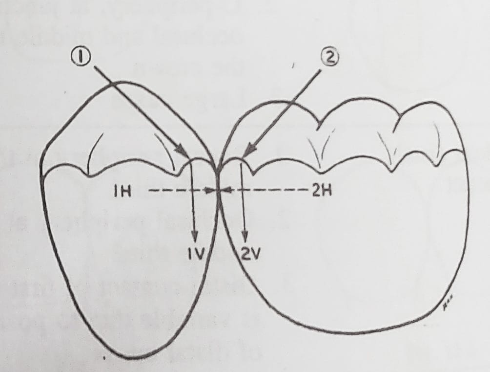 Dr. - How Important is marginal ridge and it's impact on fracture ...