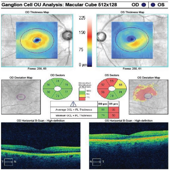 Review - Ultra-widefield Imaging Detects 83% of Peripheral Retinal ...