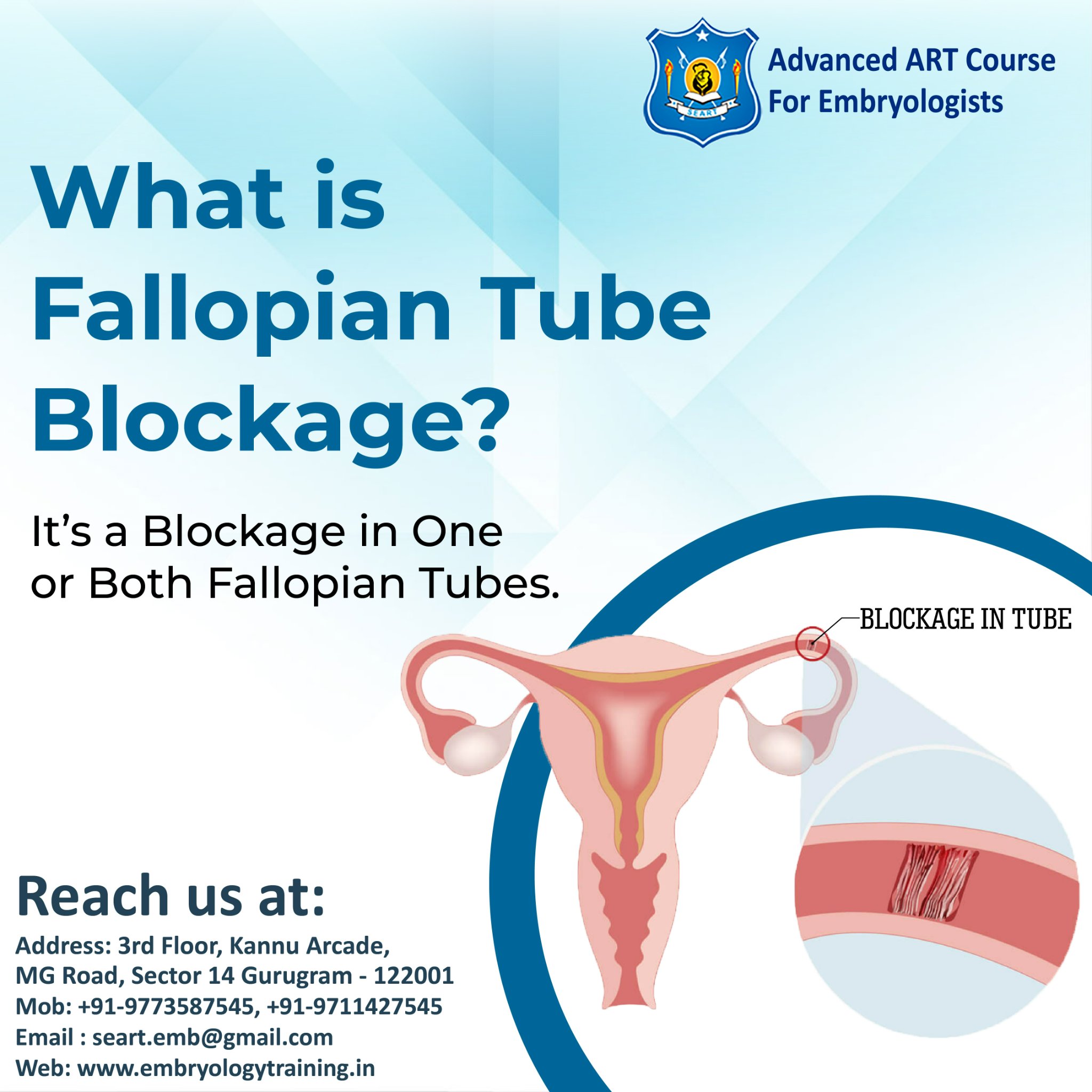 What Is Fallopian Tube Blockage? The fallopian tubes are responsible ...