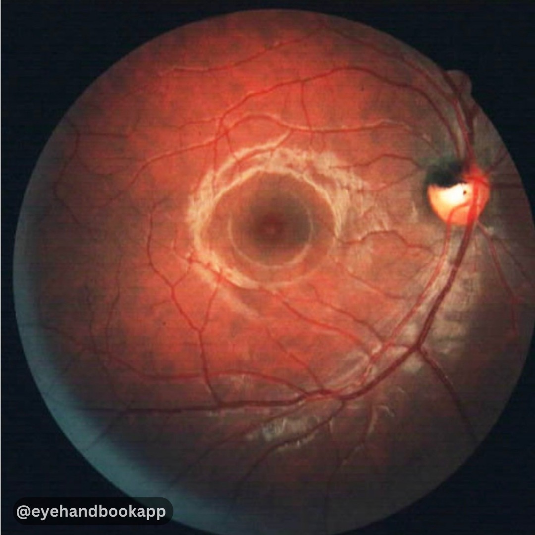 Here's a sampling of anterior segment disease photos from our new