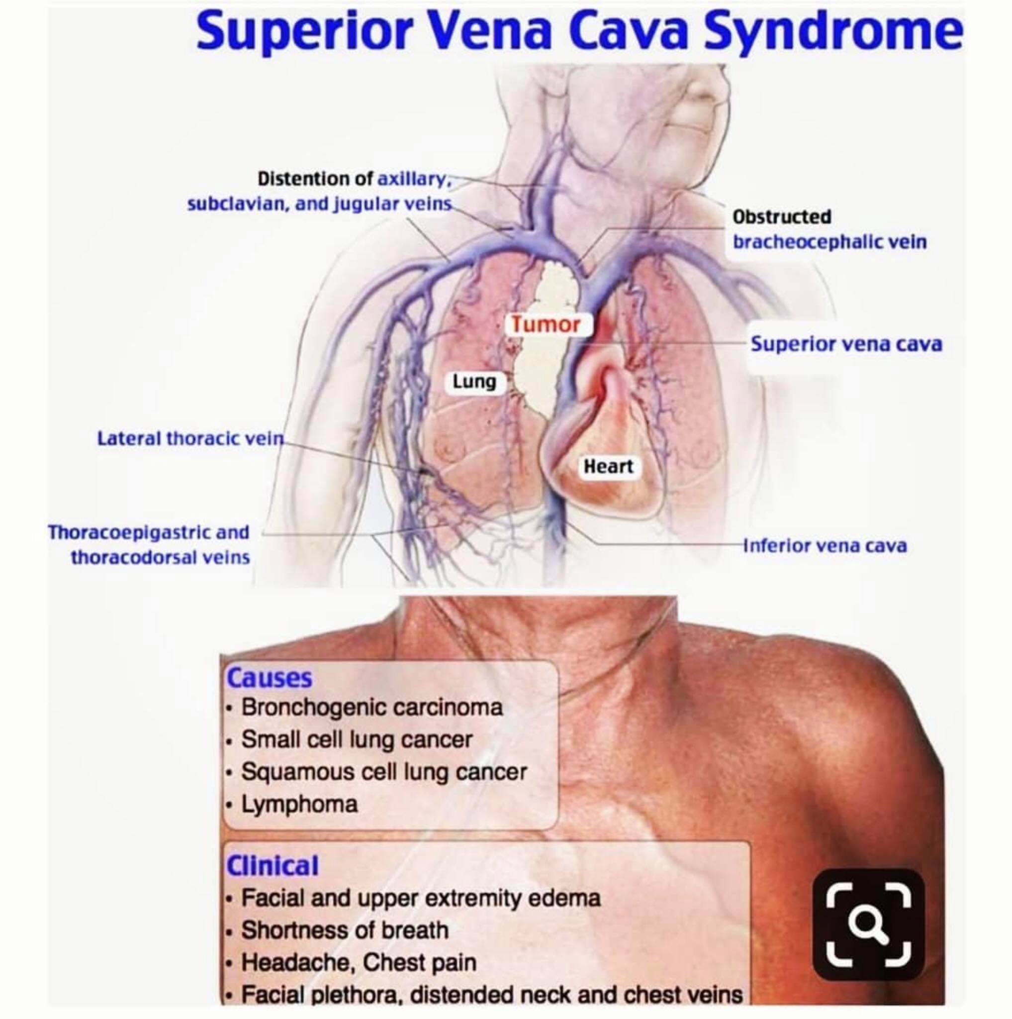 Superior Vena Cava Syndrome Face