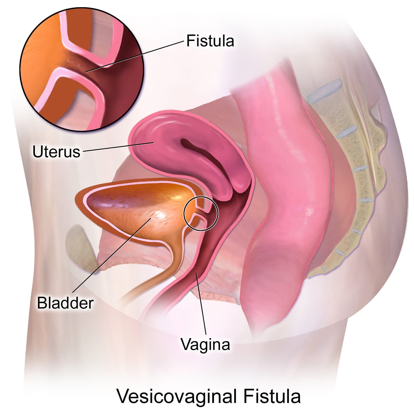 bpc 157 fistula Here are 5 key things you should know about obstetric Tank Size:20 gallon long Ice Pans cognitive health