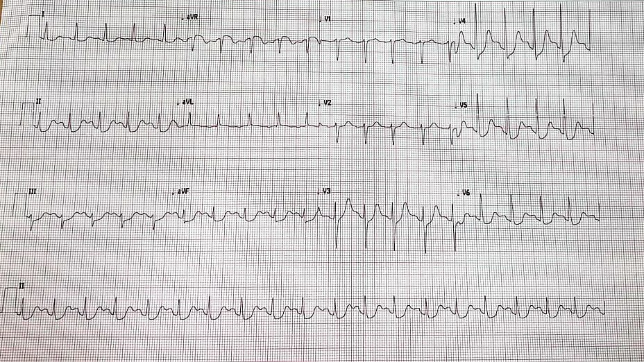 The Two Docs - ECG Quiz What is the rhythm? A. SVT B....