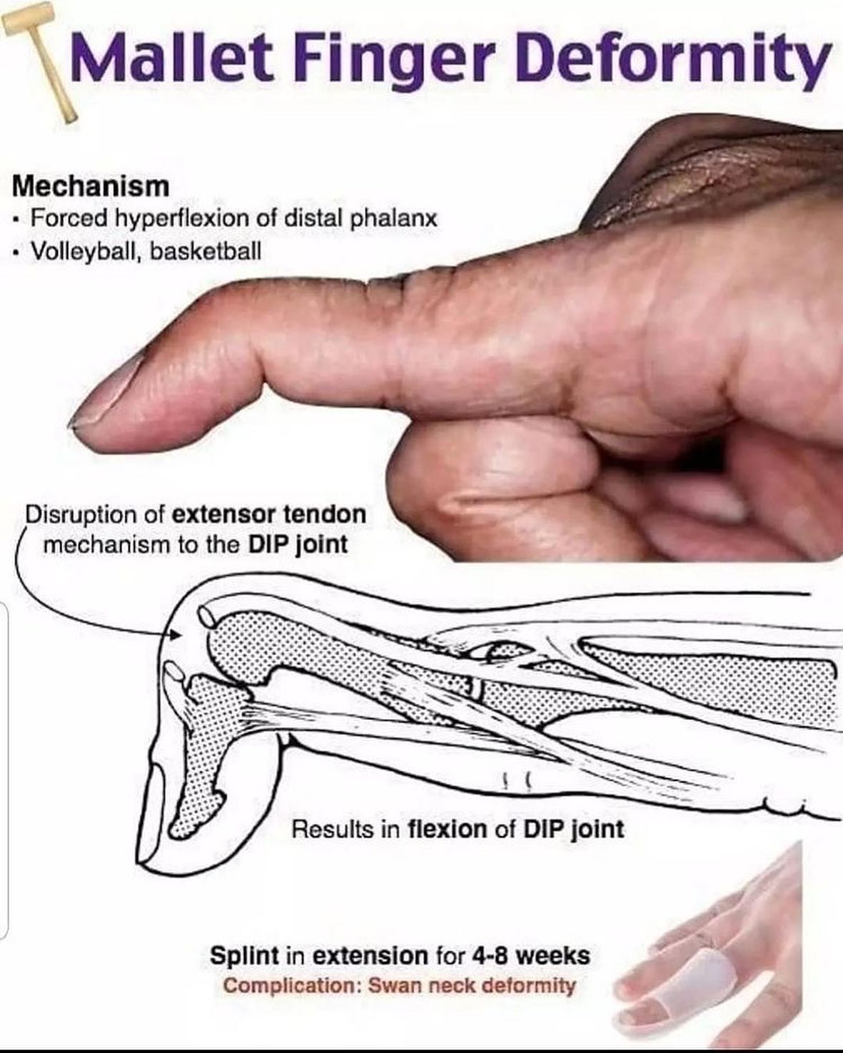 Mallet finger: MOI: axial load on... - Disgruntled Docs