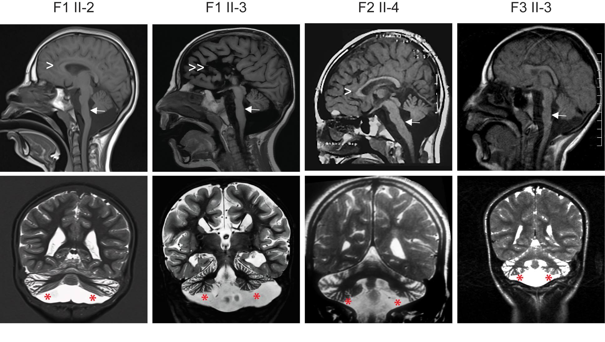 Pontocerebellar hypoplasia represents a group of clinically and ...
