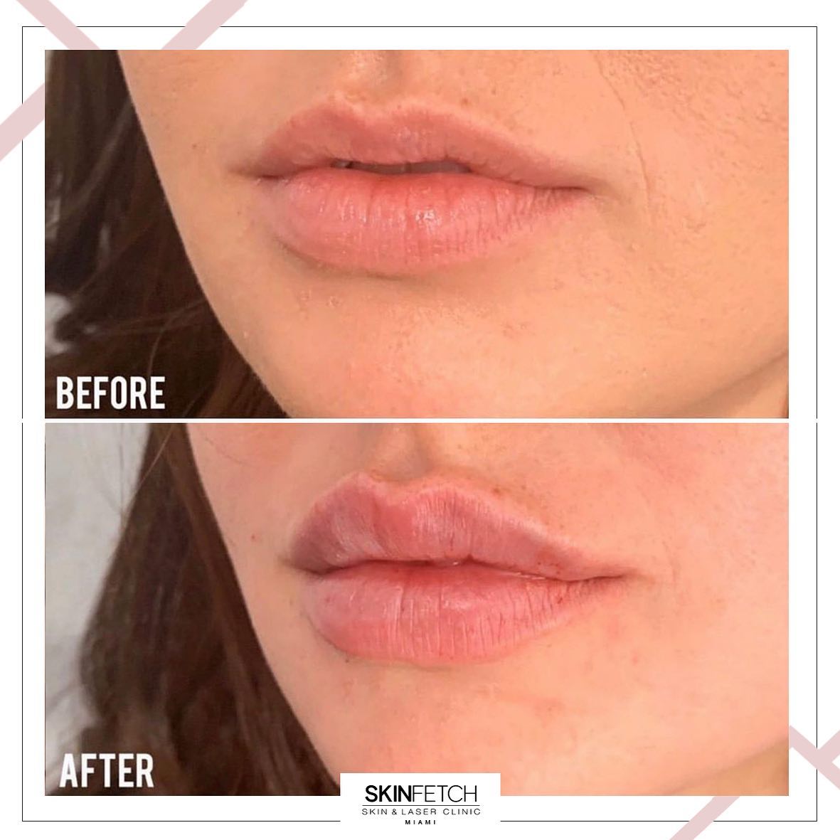 Skinfetch miami - What a difference one syringe of... | Facebook