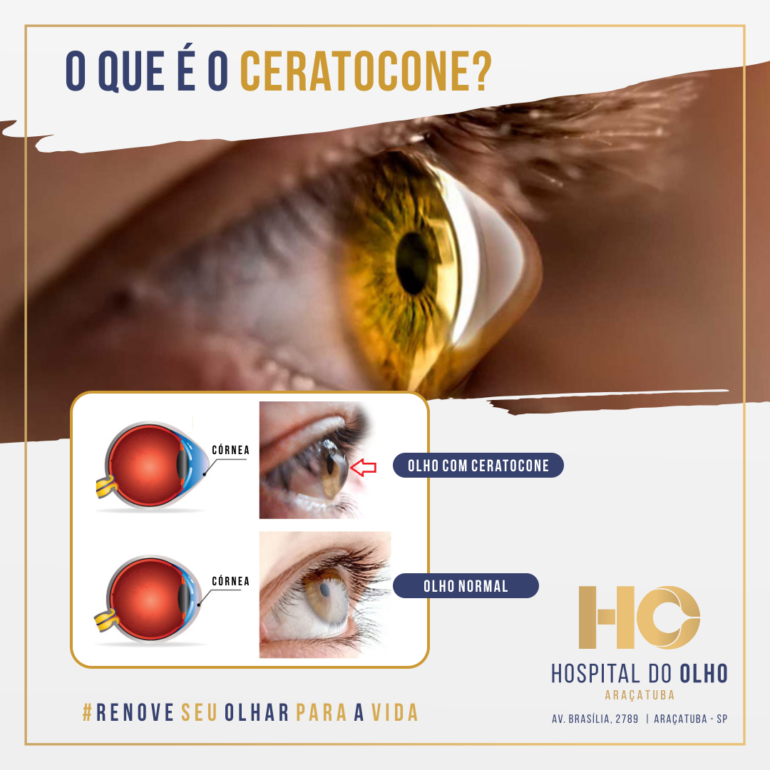 Hospital do Olho Araçatuba - Oftalmologia - O Ceratocone é uma doença ...