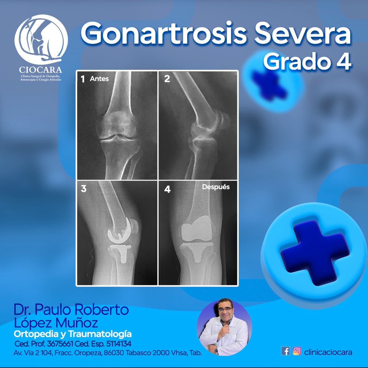Ciocara - 👉La gonartrosis es una enfermedad articular crónica ...