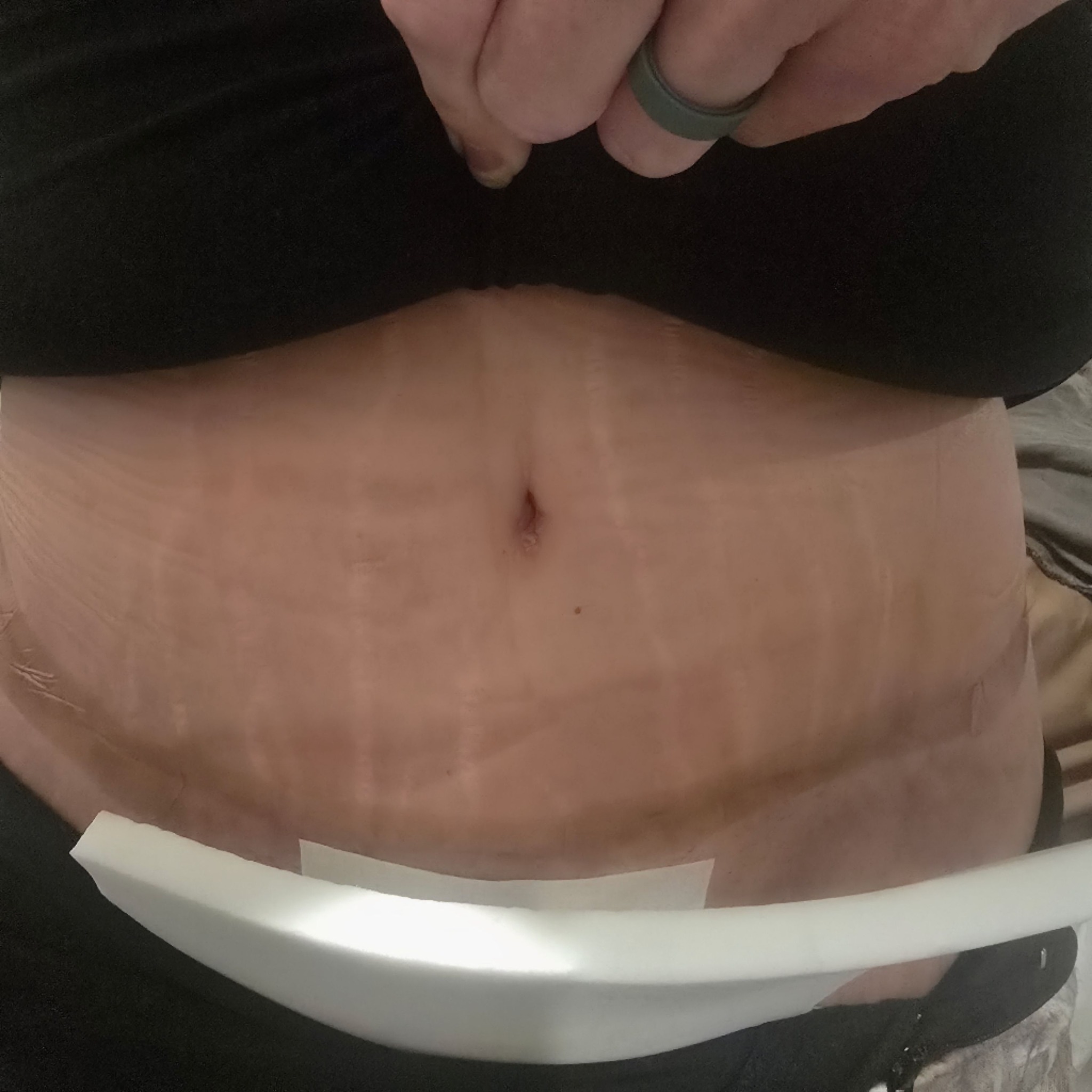 glp 1 belly button The 3 Most Common GLP-1 Injection Sites glp 1 belly button One