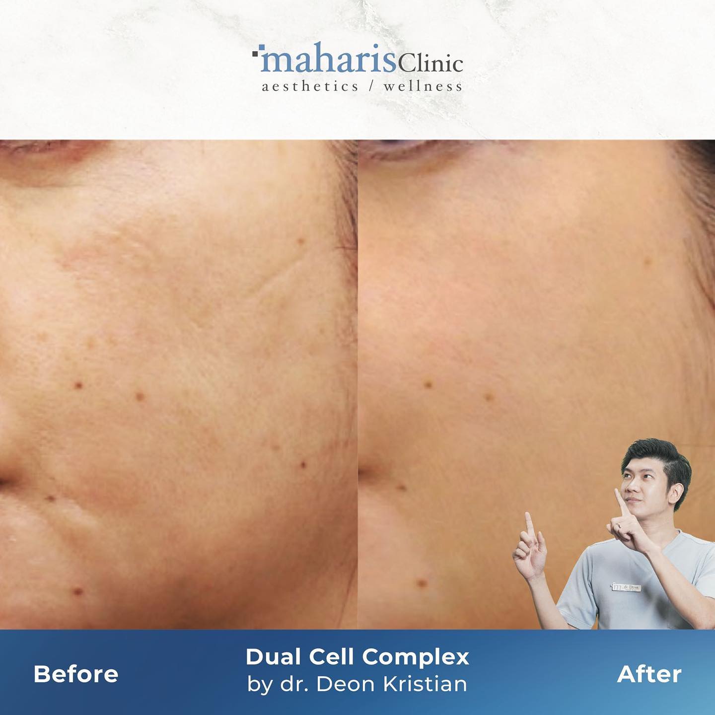 Maharis - Bikin kulit jadi 5 tahun lebih muda dengan treatment ini ...