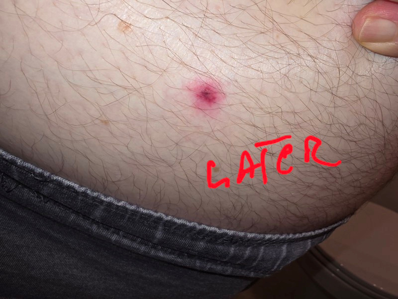 is skin sensitivity a side effect of semaglutide effects pain Can Cause Sensitivity? What to Know Semaglutide Side Effects: Common vs – semaglutide dosage on syringe Azithromycin 500 MG STRENGTH:10 MG