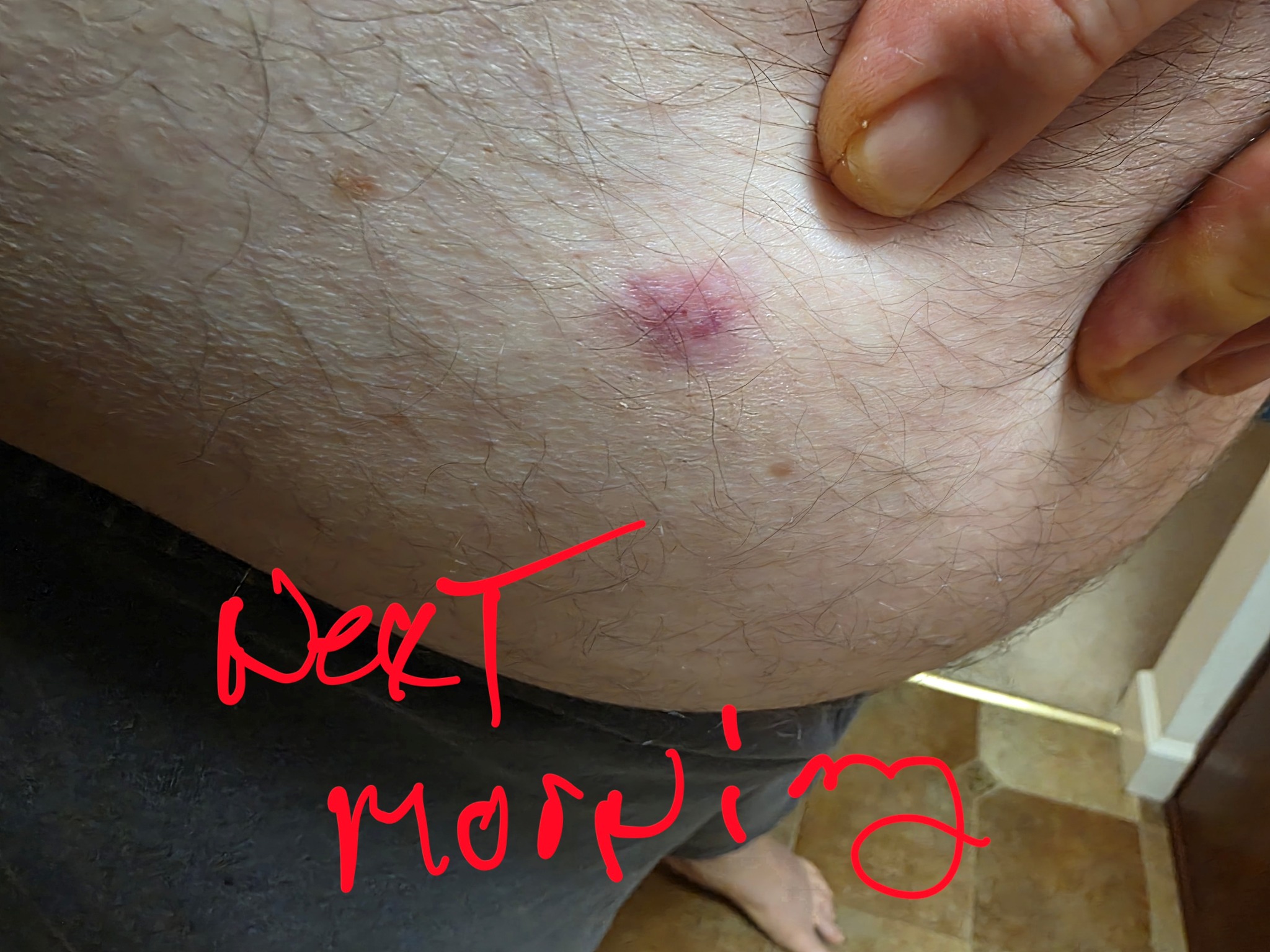 What causes Ozempic injection site blood marks?