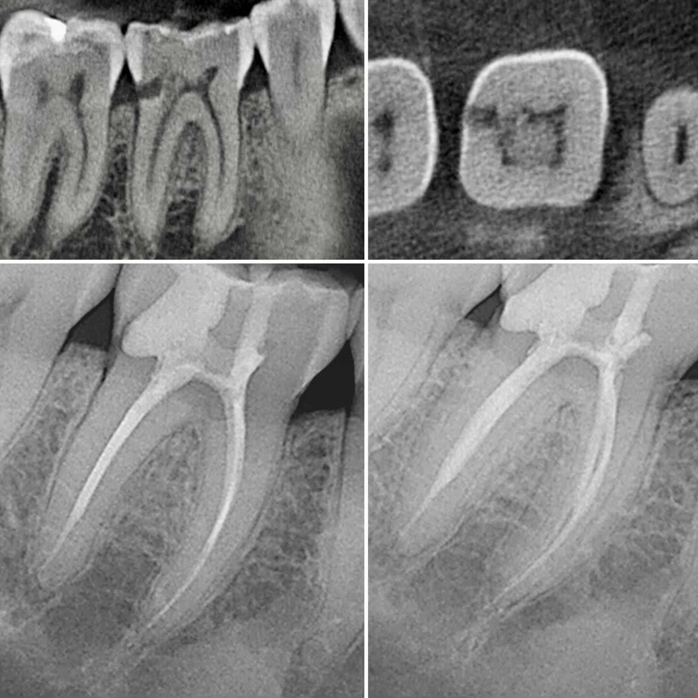 Molar Endo with conservative instrumentation. Ready for a crown. # ...