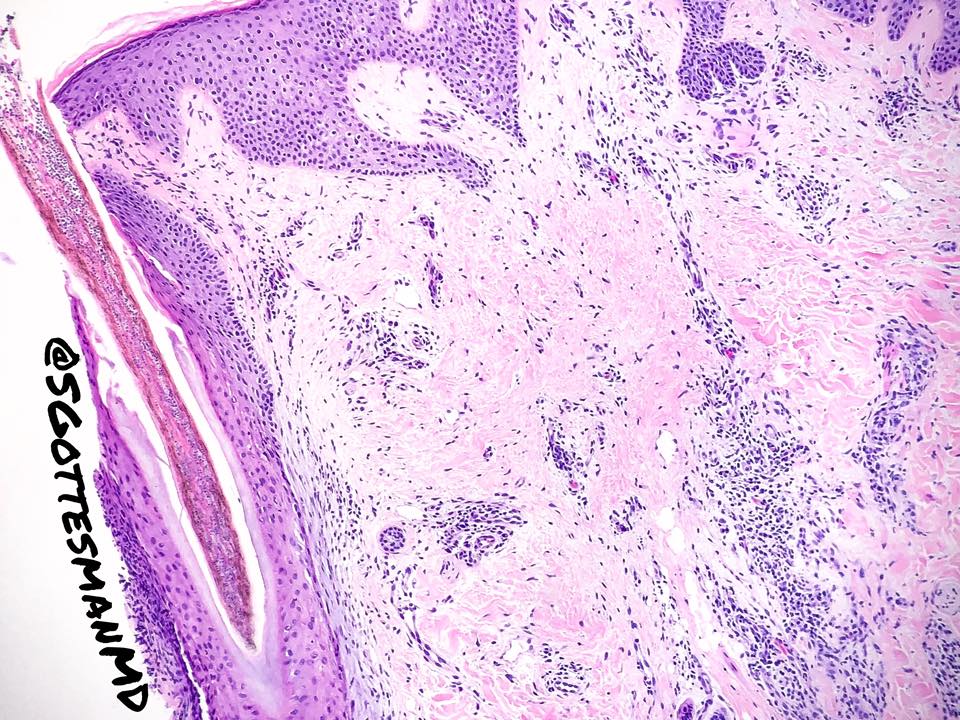 Monday morning treat. Endothrix... - Silvija Gottesman, MD | Facebook
