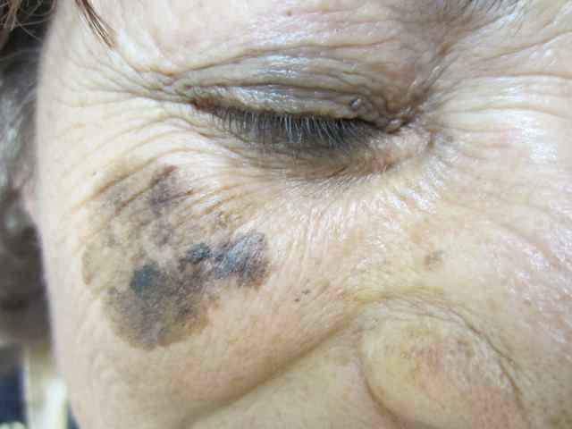 melanotic freckle of hutchinson A 76-year-old woman presents to your office with a 1 × 1-cm flat pink lesion on the right cheek, close to the lower eyelid (Figure 1-1). A full thickness biopsy is consistent Glutathione Collagen Gummies, Glutathione Flavors:Lunar Pop On Promotion