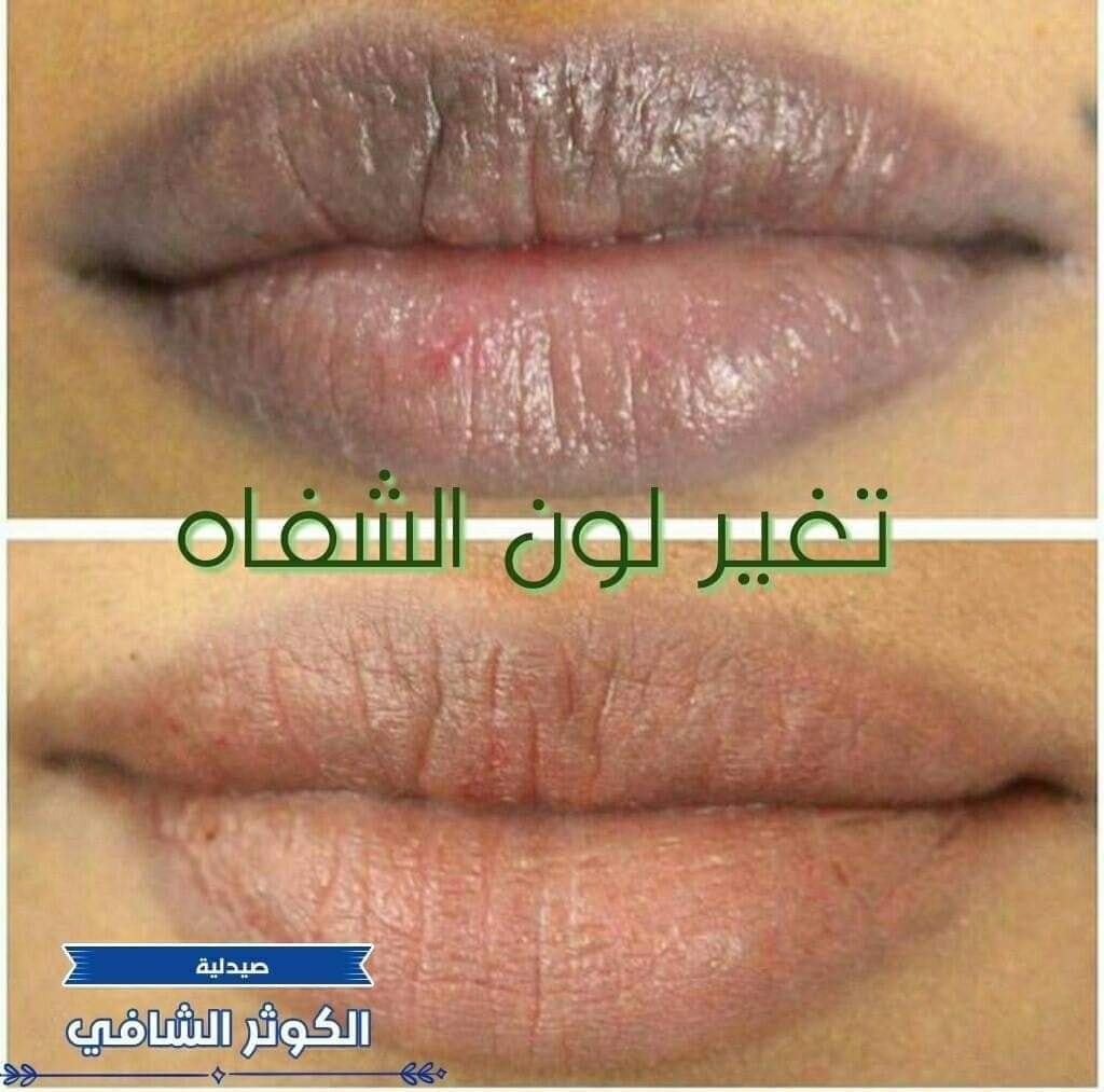 صيدلية الكوثر الشافي ما هو لون الشفاه الطبيعي موضوع اليوم هو لون الشفاه إن اللون الطبيعي للشفاه هو اللون الوردي أو الأحمر الفاتح لانها عبارة عن طبقة رقيقة من الجلد وتحتها
