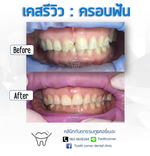 Tooth Corner Clinic - ทูธคอร์เนอะ สหคลินิก - สวัสดีค่ะ วันนี้แอดมินจะมา ...