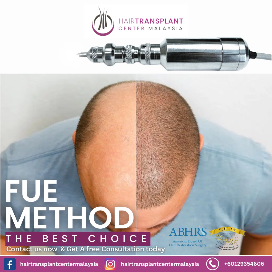 Since the FUE process... - Hair Transplant Center Malaysia | Facebook