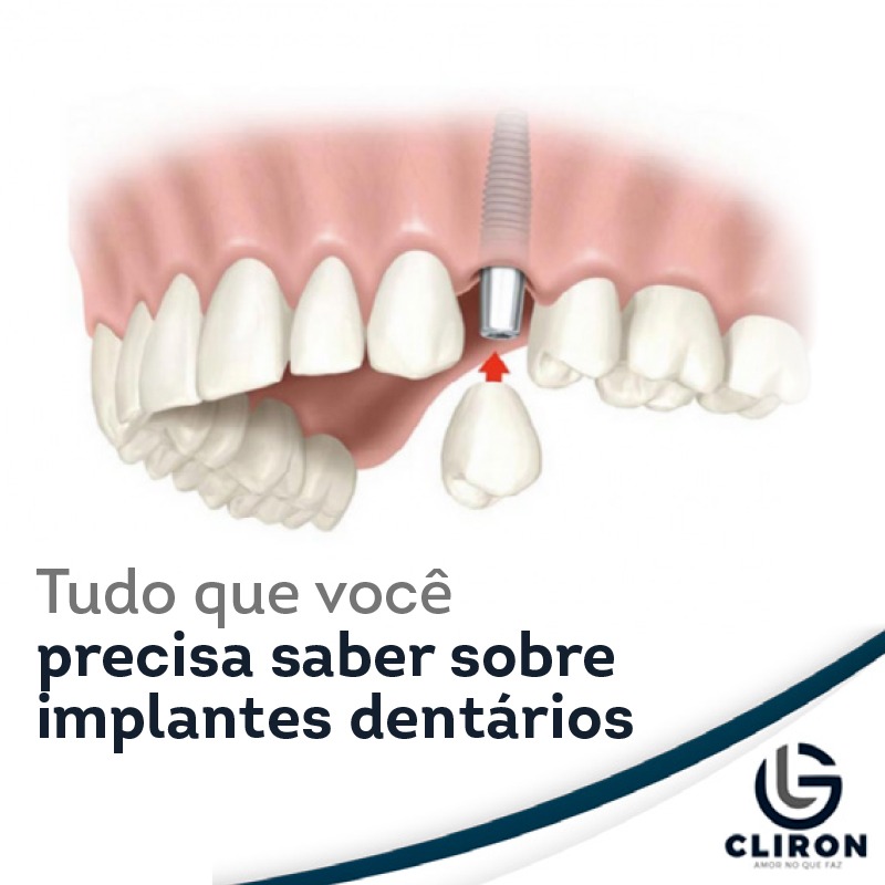 Clínica Cliron - O implante dentário é um tratamento...