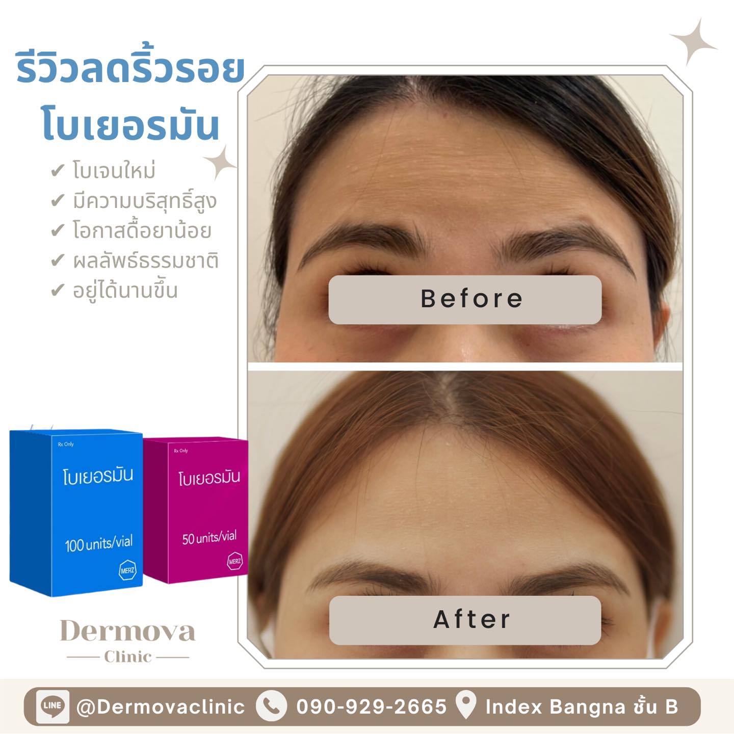 Dermova Clinic - รีวิวลดริ้วรอย ล็อคความอ่อนเยาว์ ด้วย... | Facebook