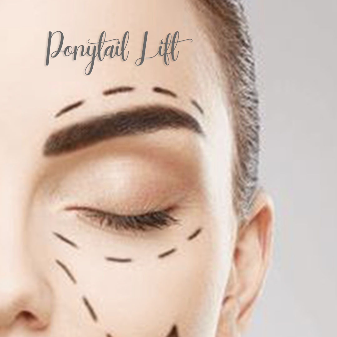 The ponytail lift is a... - Verdun Clinic by Dr Maya Adhami | Facebook