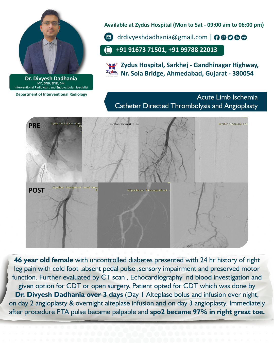 Dr - Acute Limb Ischemia Catheter Directed Thrombolysis and Angioplasty ...