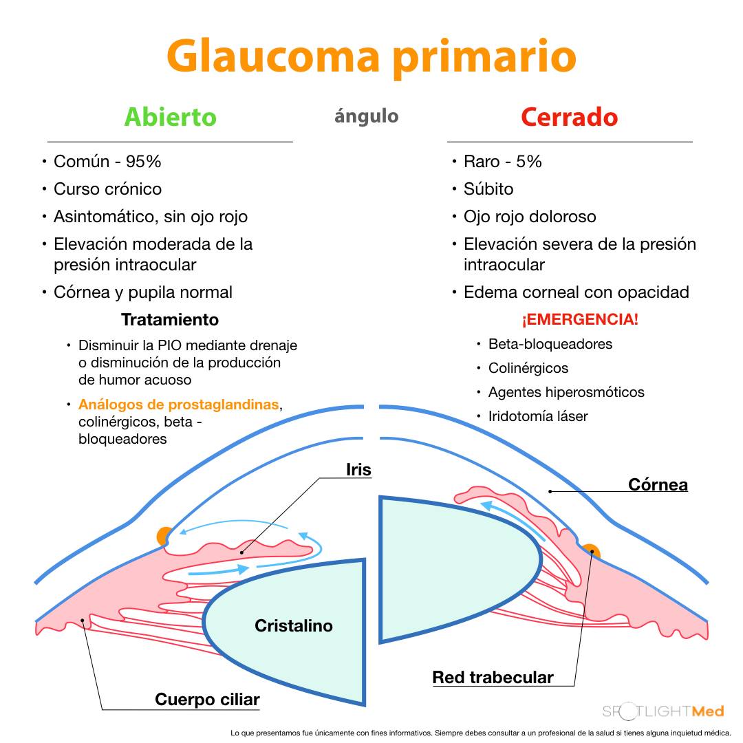 SpotlightMed - Glaucoma primario ángulo abierto vs cerrado 👀 # ...