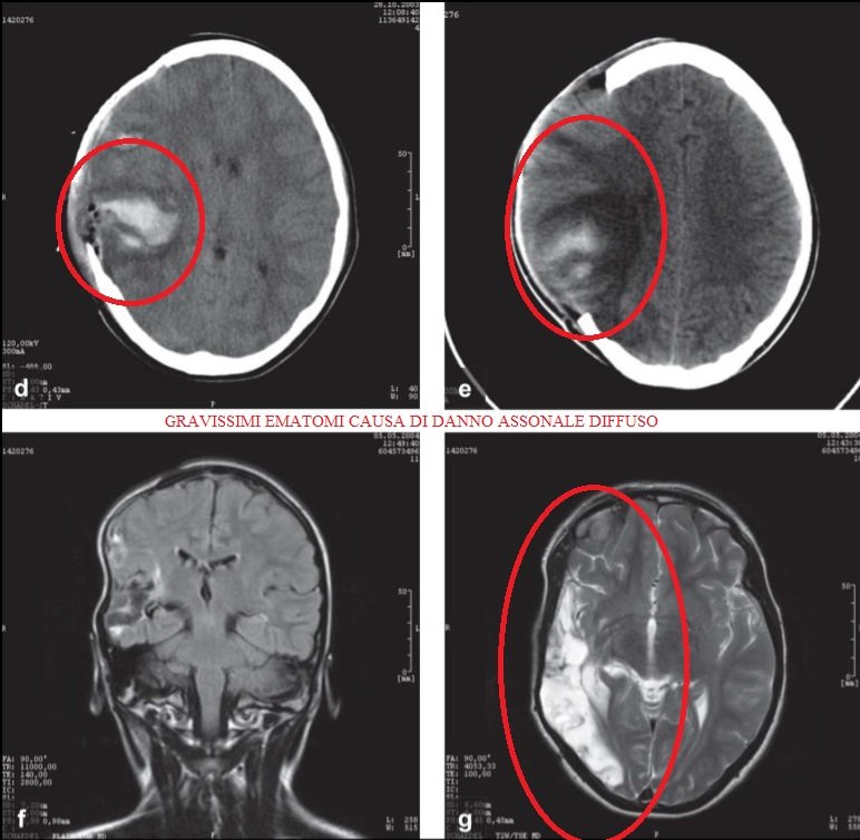 Il danno cerebrale da trauma cranico è una entità nosografica molto ...
