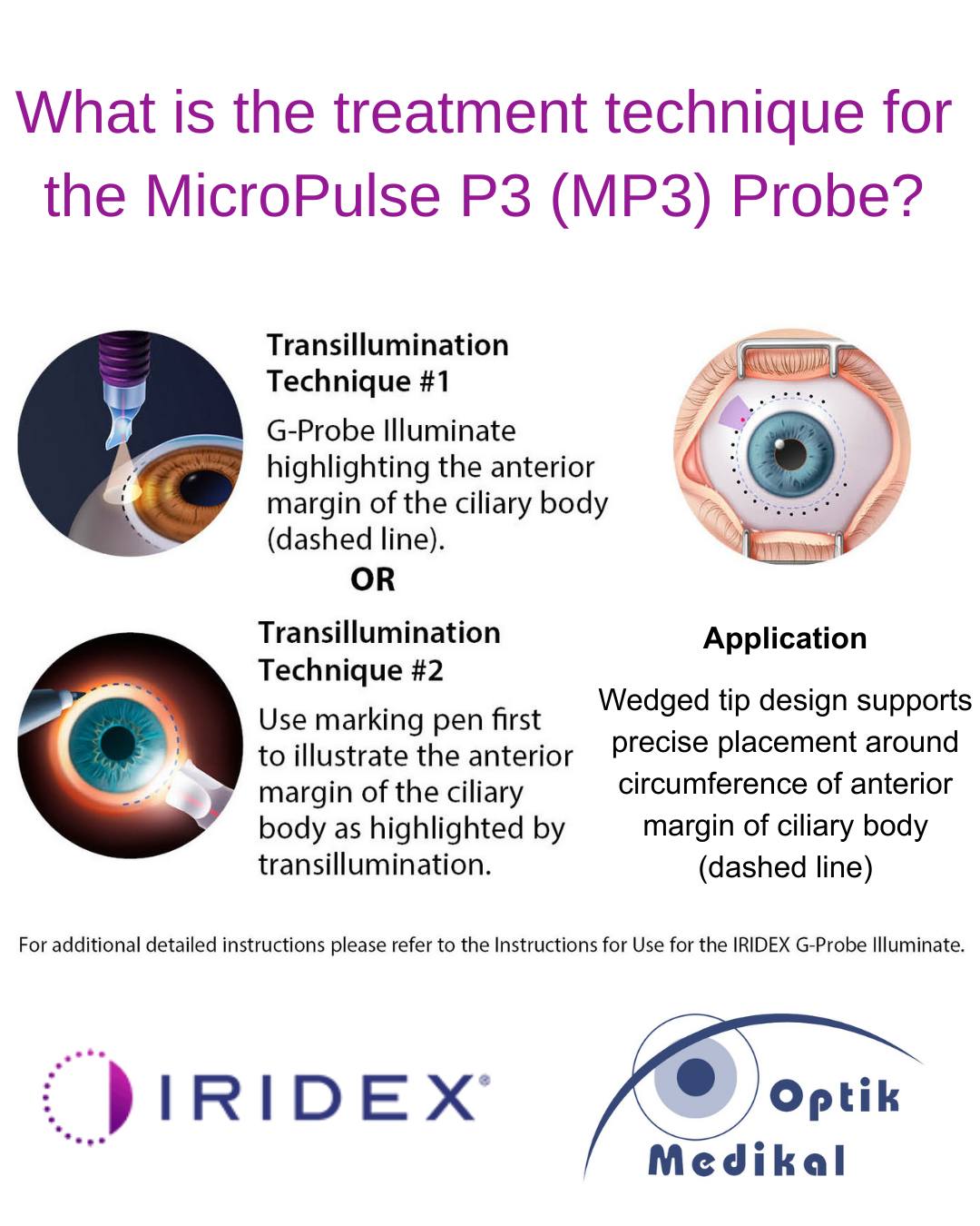 Optik Medikal - MicroPulse P3 (MP3) Probe ile glokom... | Facebook