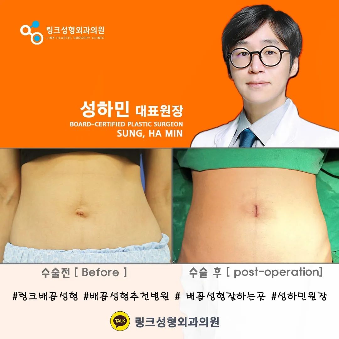링크성형외과 - _일자배꼽성형 #배꼽성형#배꼽수술#일자배꼽#배꼽성형추천 👉7월 이벤트 200만원...