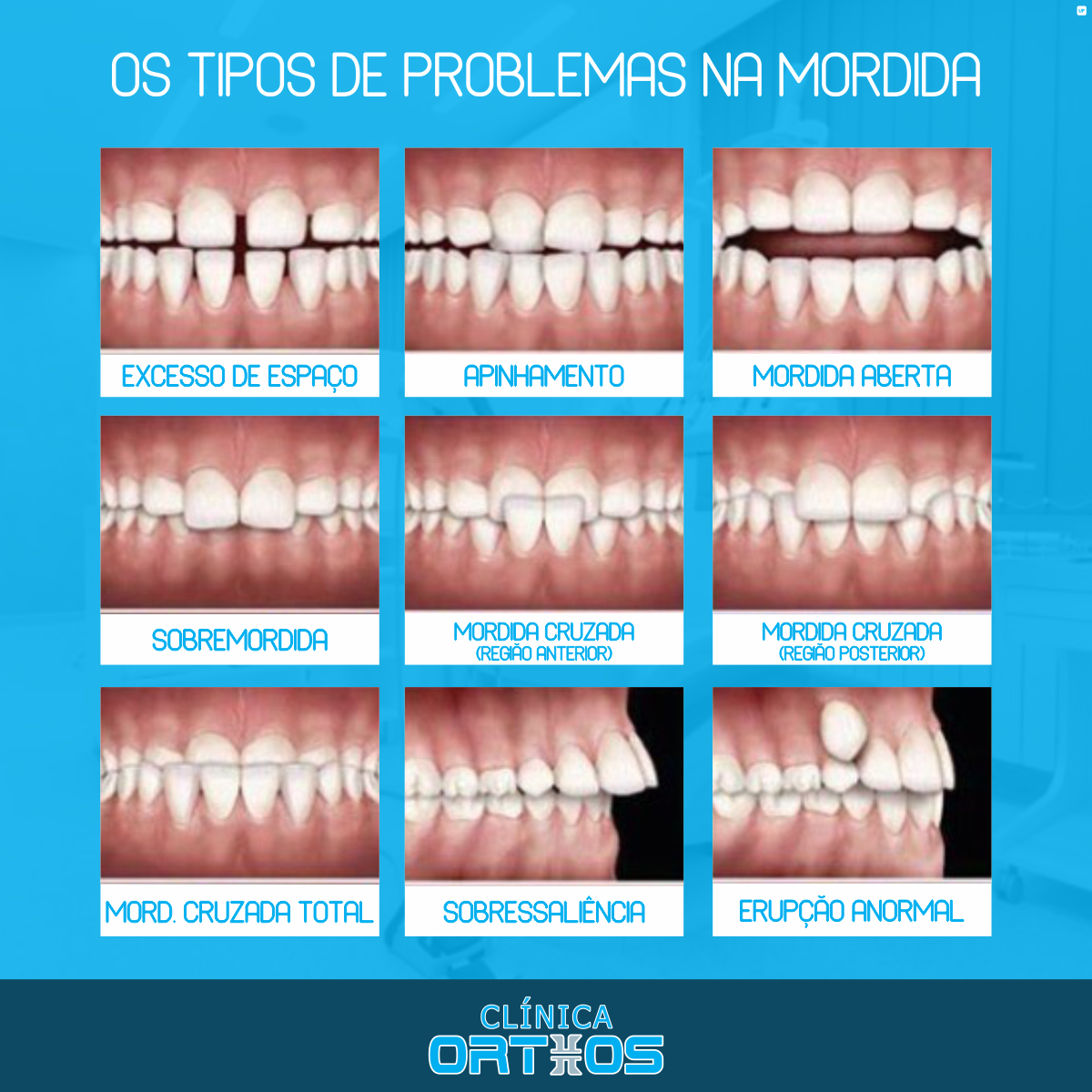 Clínica Orthos - A identificação do tipo de mordida e sua... | Facebook