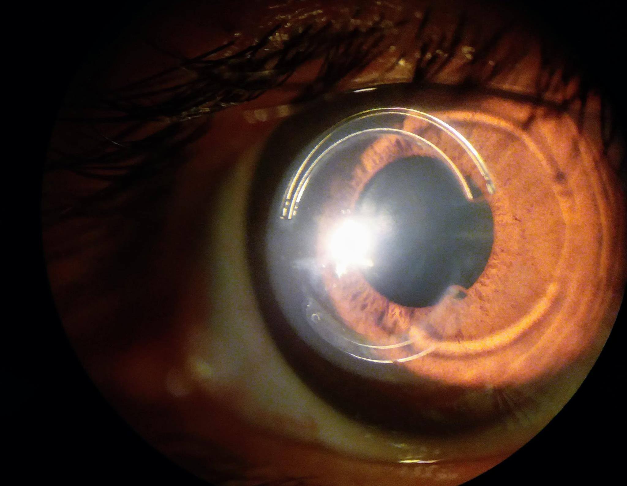 LENTES... - Contactología Especializada en Queratocono | Facebook