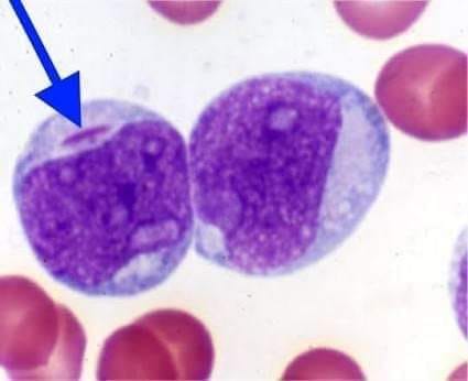 Lines - Auer rods 💉 Auer rods are clumps of azurophilic granular ...
