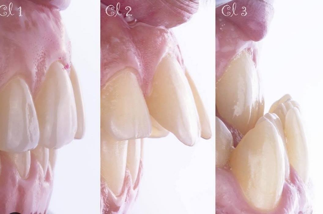 Radice anteriore del menisco mediale - e-Anatomy