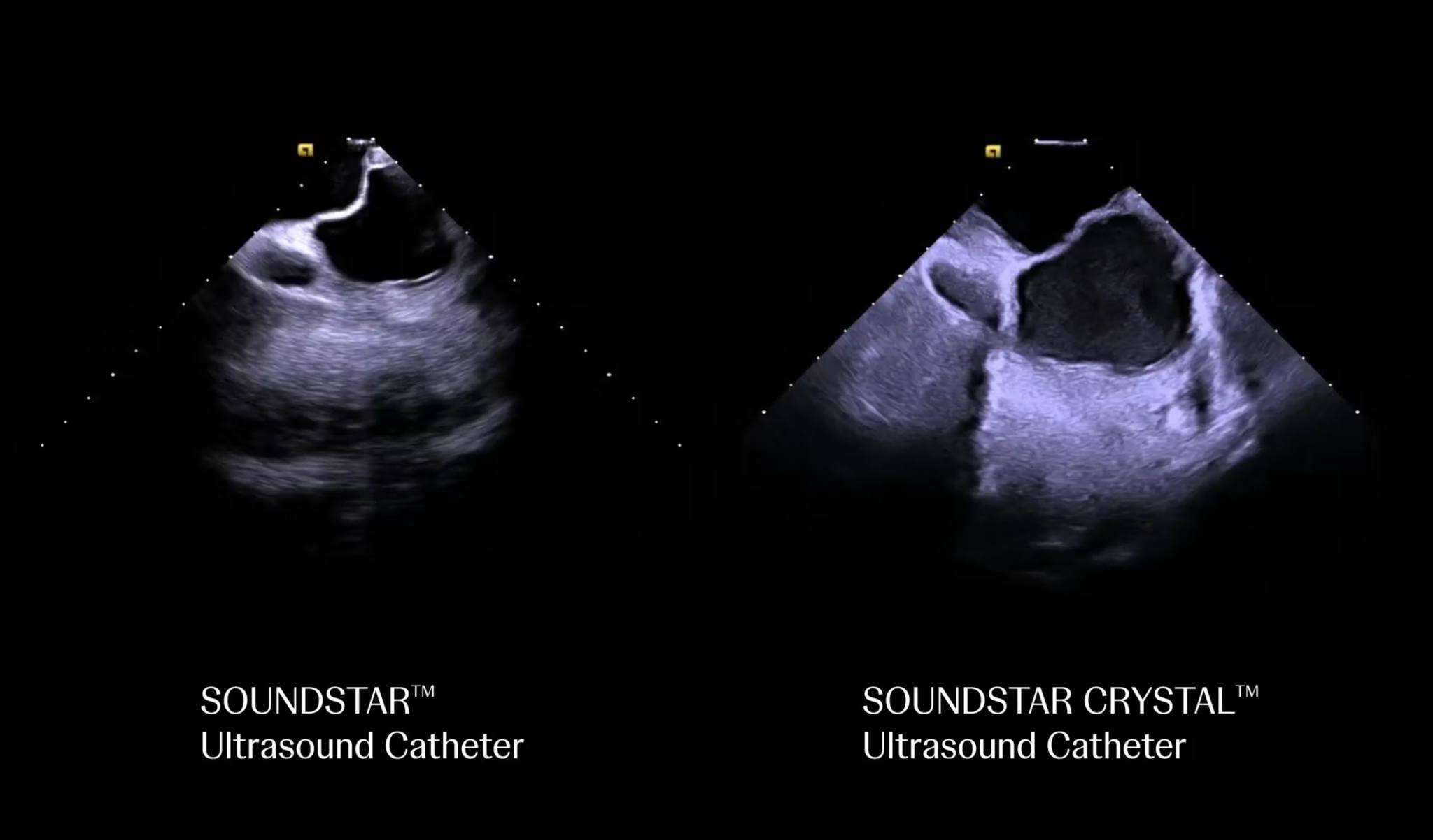 EP - Discover why Johnson & Johnson MedTech's SOUNDSTAR CRYSTAL