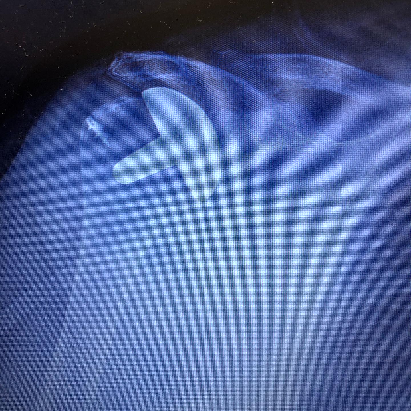 Bones & Joints Clinic - Femoral notching during TKA weakens the cortex ...