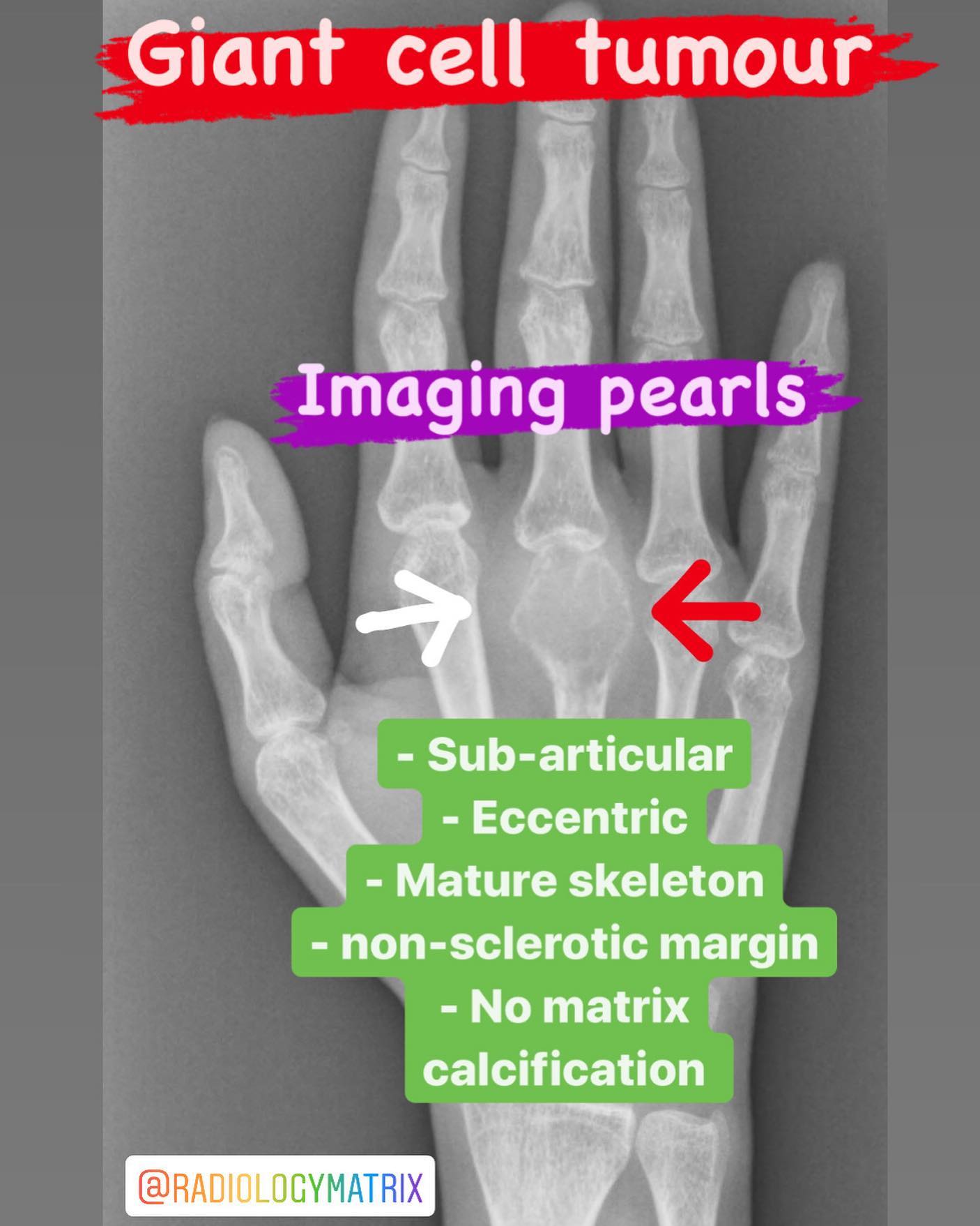 Radiology Matrix - medical education - Giant cell tumors of bone, also ...