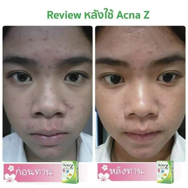 บ้านต้นยาเภสัช - กลไกการออกฤทธิ์ของ Acna Z (แอคน่า ซี)... | Facebook