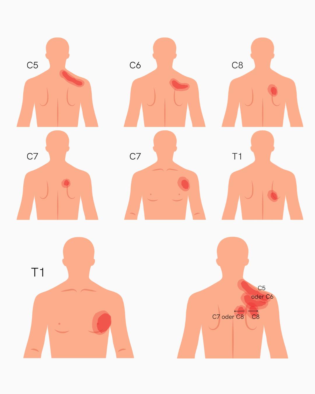 𝗖5‑𝗧1 𝗿𝗮𝗱𝗶𝗰𝘂𝗹𝗮𝗿 𝗽𝗮𝗶𝗻 𝘄𝗶𝘁𝗵𝗼𝘂𝘁 𝗮𝗿𝗺 𝗽𝗮𝗶𝗻 Lower cervical levels (C4–C5, C5–C6, C6–C7, C7–T1) are the most common sites for disc herniations and spondylosis. Given that all the roots exiting at these levels