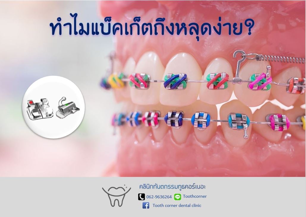 ทำไมแบ็คเก็ตจึ... - Tooth Corner Clinic - ทูธคอร์เนอะ สหคลินิก | Facebook