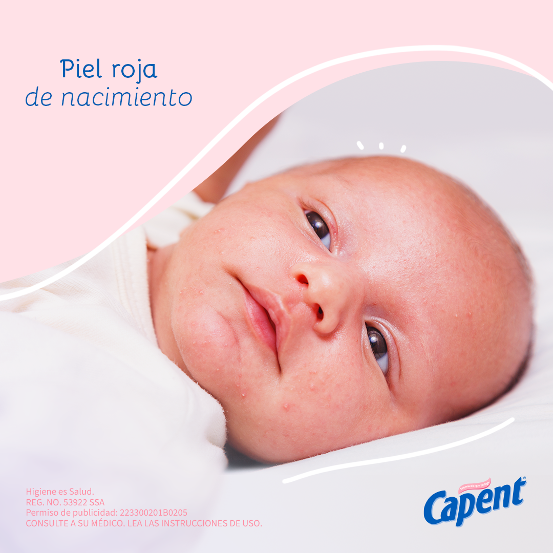 Capent México - El tono rojizo que algunos bebés recién... | Facebook