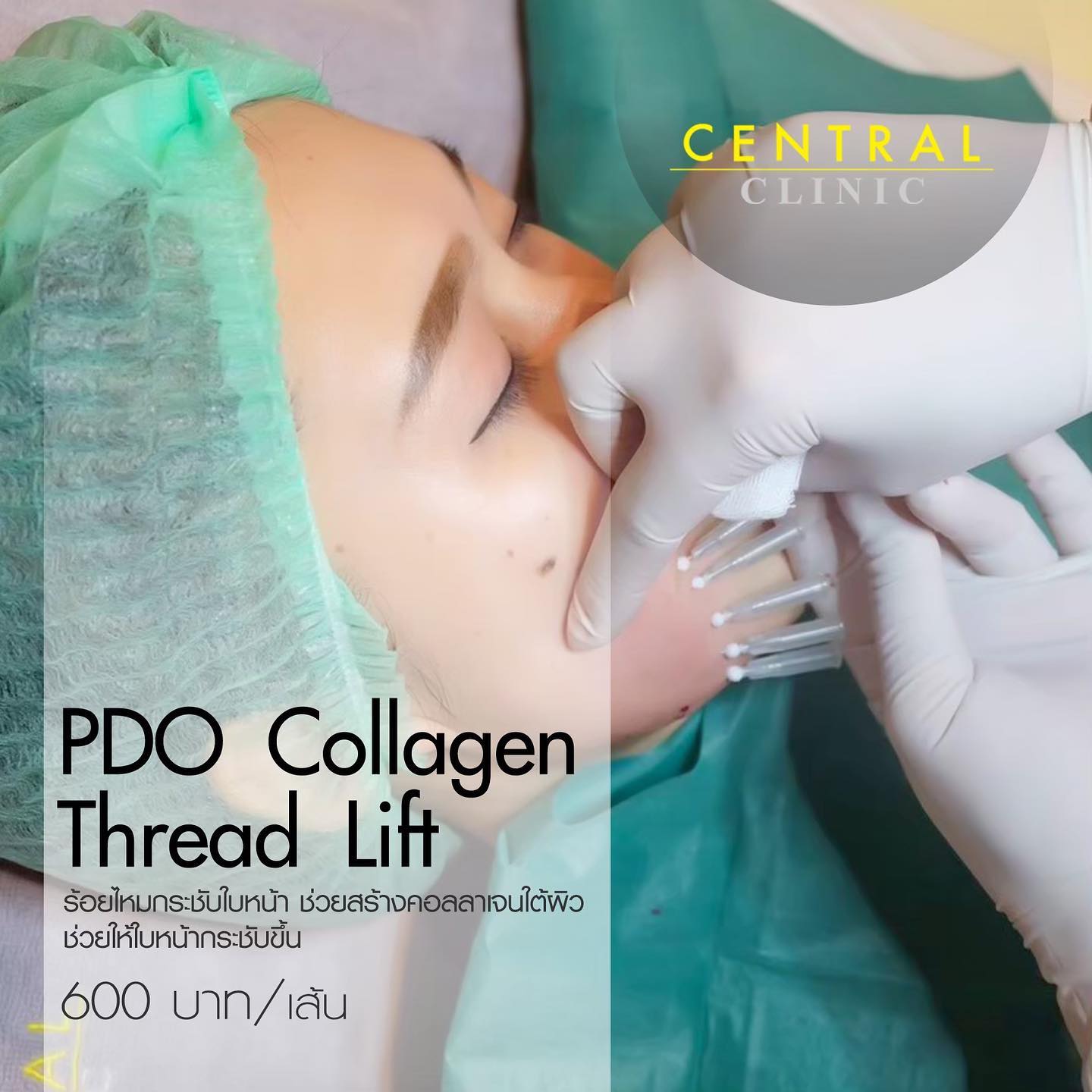 Central Clinic - PDO Collagen Thread Lift 🤍...