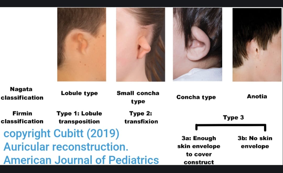 ENT Facial Plastic Surgery Baguio - Anotia and microtia are congenital ...