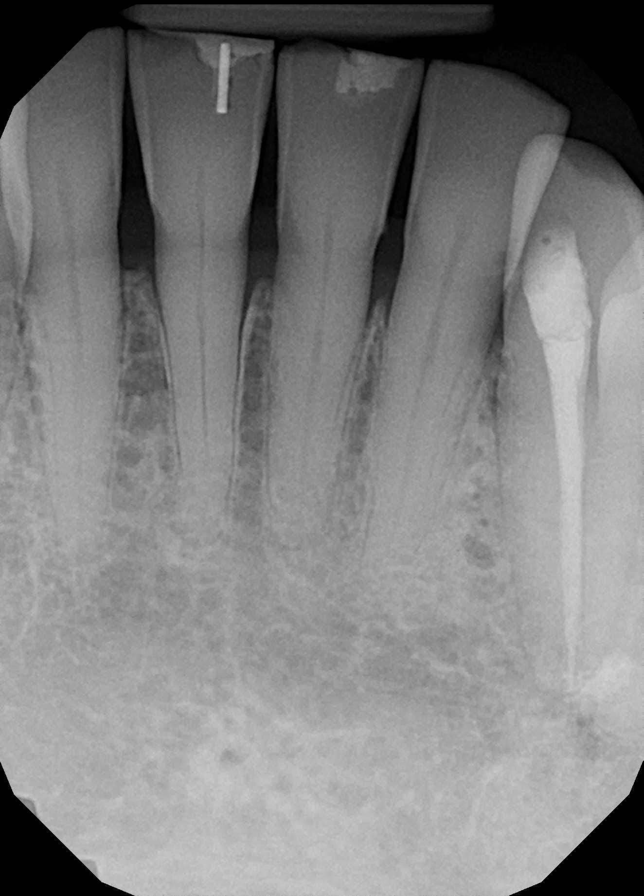 DentXpin