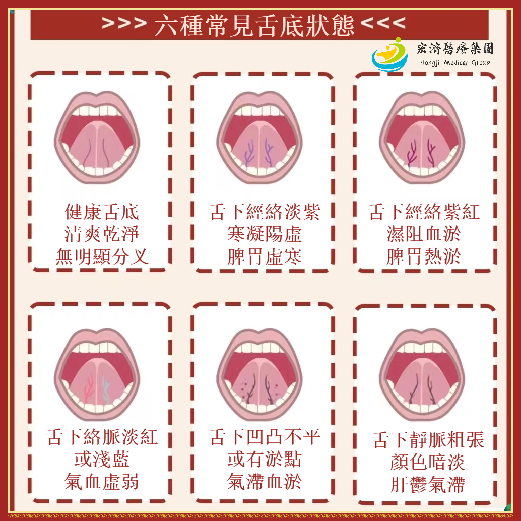 宏濟醫療集團 - 👀看舌底辨健康 | 六種常見舌底狀態 之前簡單寫過一篇舌底自測，好多朋友都有興趣了解更多細節 🏻... | Facebook