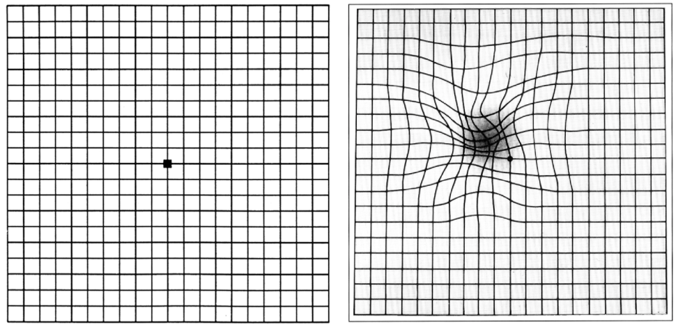 Georgia Optometric Association - Are you familiar with the Amsler grid ...