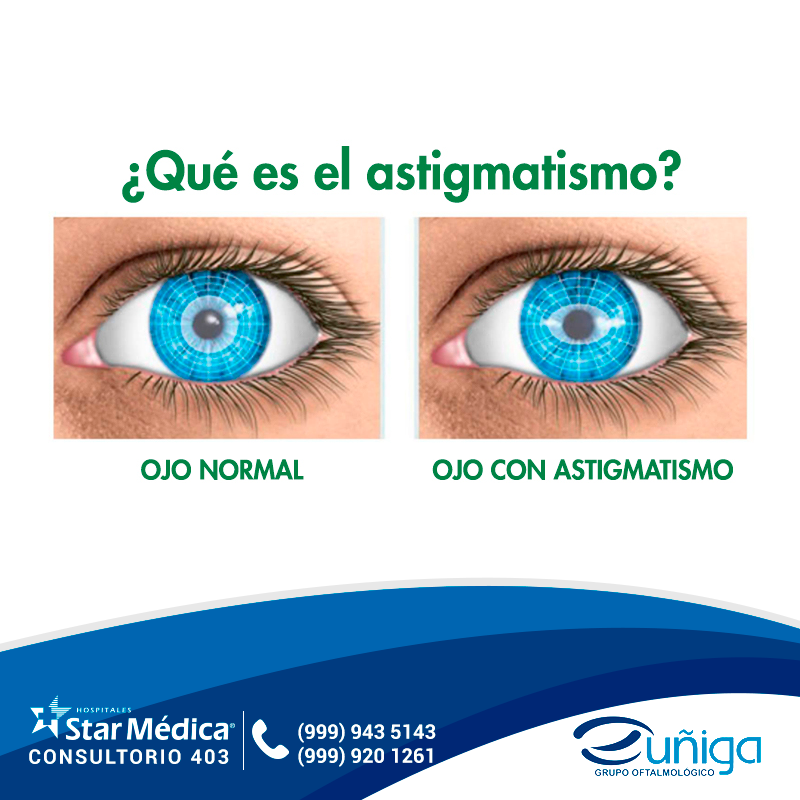 astigmatismo las personas con grupo oftalmologico zuniga facebook astigmatismo las personas con