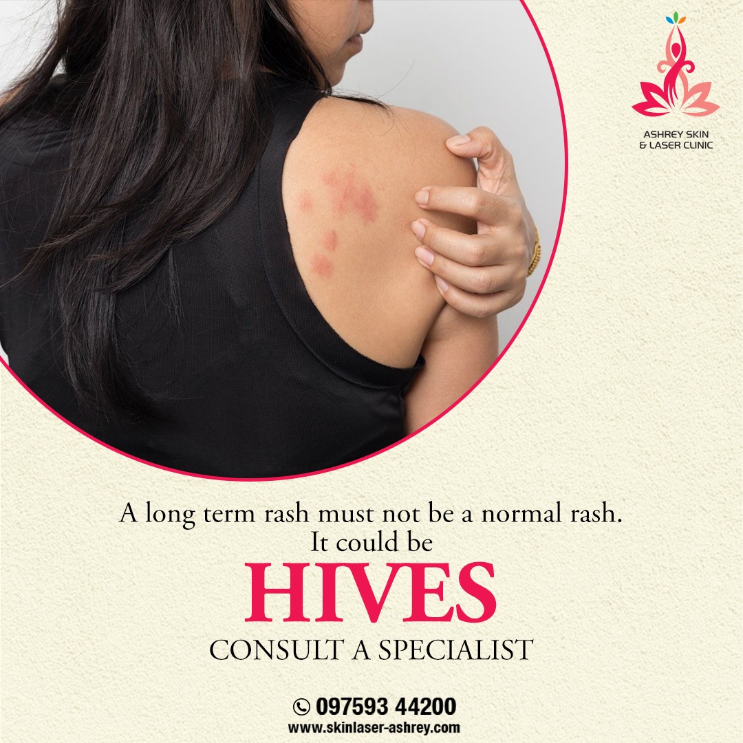 Ashrey skin care centre and laser clinic - Don't take your rashes ...
