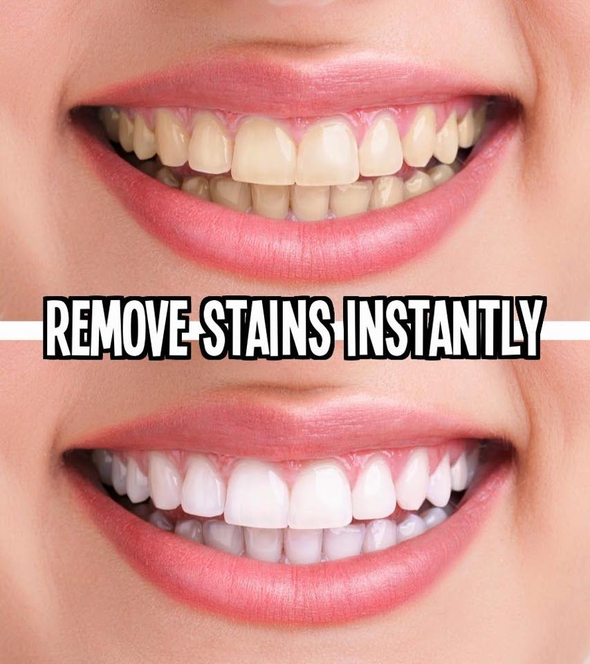Platinum Smile Teeth Whitening - Posts | Facebook