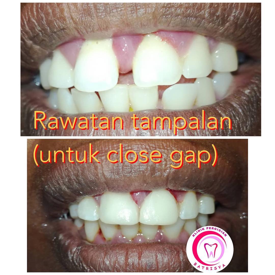 Rawatan tampalan untuk menutup... - Klinik Pergigian Batrisya